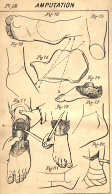 Black and white illustration of techniques for amputating hands and feet.