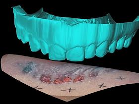 Computer reconstruction of bite mark, 2003