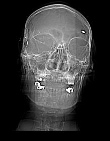 Classical CT scout view, 2003