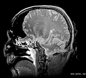 This MRI cross section shows the wound track through the brain stem and the cerebellum (see arrow), 2003