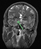 MRI cross section showing brain tissue details and the bullet track